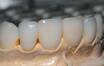 Разновидности коронок для зубов