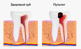 Пульпит зуба: причины, симптомы и современные методы лечения