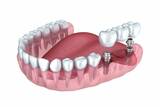 Протезирование зубов: что это и как оно происходит?